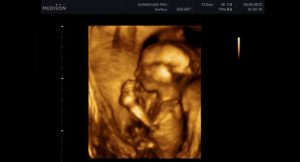 3d узи 14 недель