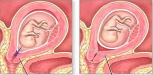 Зашить шейку матки на 26 неделе беременности