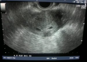 Узи после эко на 3 недели