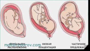 Низкая плацентация на 33 неделе беременности
