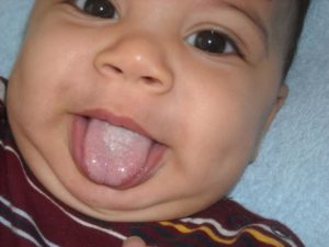 Как выглядит молочница во рту у младенцев?