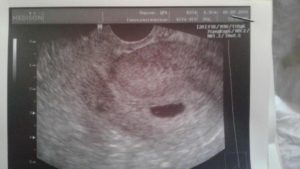 Узи после эко на 3 недели