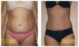 Ультразвуковая кавитация побочные эффекты