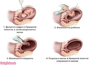 Кесарево сечение на 38 неделе беременности