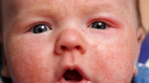 Чем лечить у новорожденного диатез