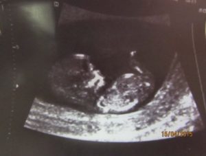 Замершая беременность в 12 недель