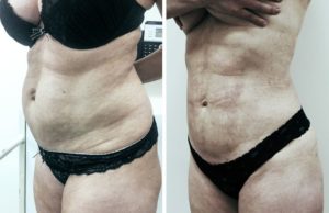 Как убрать висячий живот у мужчин?