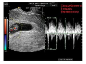 Нет сердцебиения у плода 8 недель форум