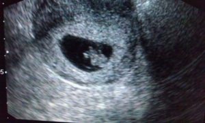 8 Недель узи 6