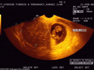 Беременность 6 недель миома матки