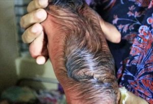 Ребенок родился с волосами на спине