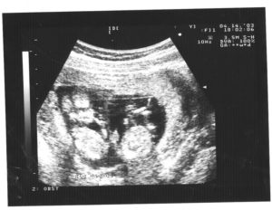11 12 Недель беременности двойня