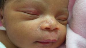 Как лечить прыщики у новорожденного на лице?