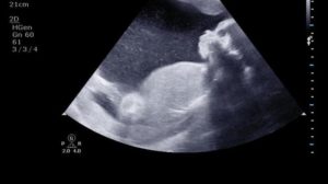 Узи в 3 триместре на какой неделе