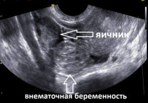 Внематочная беременность 11 недель