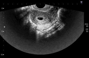 Не видно эмбрион 7 8 акушерских недель