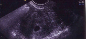 Узи 3 эмбриональной неделе