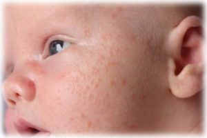 У новорожденного красные прыщи