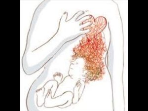 Почему изжога мучает во время беременности?