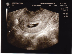 У кого 5 неделя беременности