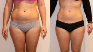 Ультразвуковая кавитация побочные эффекты