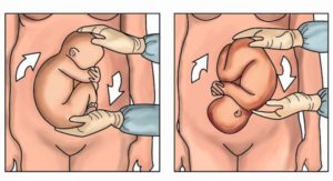 Тазовое предлежание плода на 38 неделе беременности