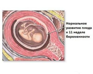 Токсикоз на 11 неделе беременности