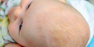 Корочки на головке новорожденного