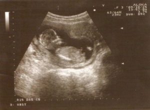 Срок 14 15 недель беременности
