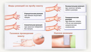 После манту правила для родителей