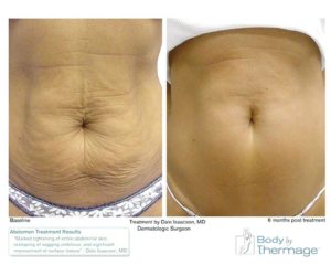 Дряблый живот после родов как убрать отзывы