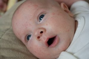 Как отличить аллергию от акне у новорожденных?