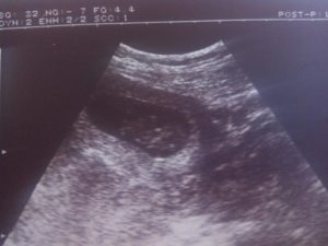 Признаки замершей беременности на 12 неделе беременности
