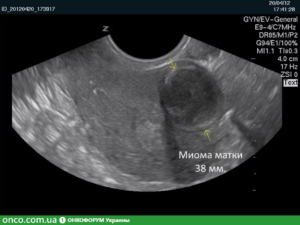 Симптомы миомы матки 8 9 недель
