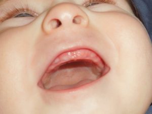 Во сколько у младенцев режутся зубы