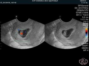 Сердцебиение эмбриона в 8 недель