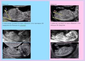 Как определить пол ребенка до 12 недель