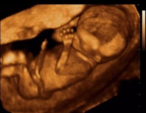 3d узи 14 недель