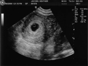 Эмбрион 4 недели узи