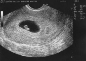 Беременность 6 недель пульсация