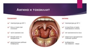 Болит горло на 14 неделе беременности