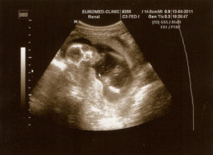 Тонус матки на 22 неделе