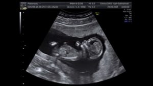 Низкая плацента при беременности 12 недель
