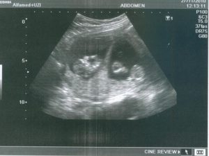 Узи после эко на 3 недели