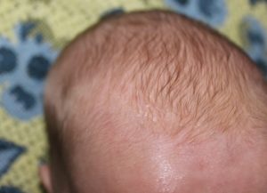 У новорожденного на голове шелушение