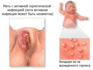 Генитальный герпес на 37 38 неделе беременности
