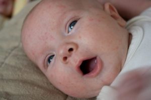 Прыщи у новорожденных на лице как лечить
