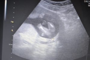 17 Недель беременности пол
