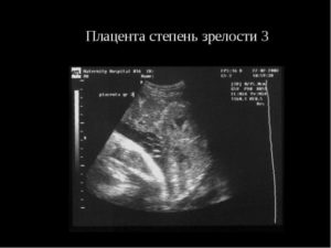 Плацента 32 недели беременности