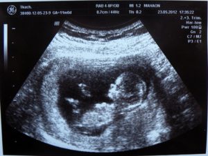 11 Недель и 5 дней беременности